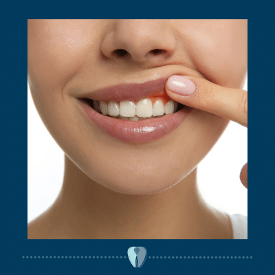 5 effective ways to prevent periodontal disease 3 Photo of woman showing inflamed gums, a sign of periodontal disease